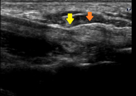 整形外科領域の超音波診断　その4