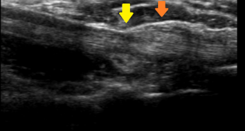 整形外科領域の超音波診断　その4